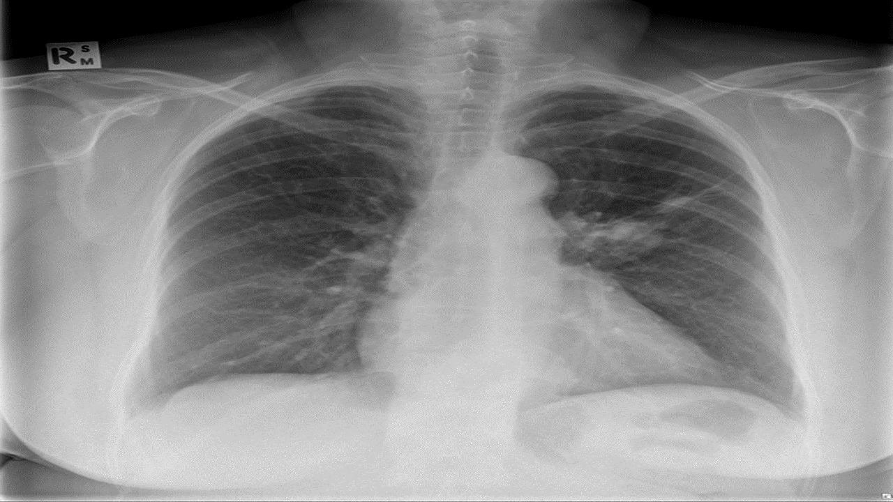 File:X ray bronchial carcinoid.gif
