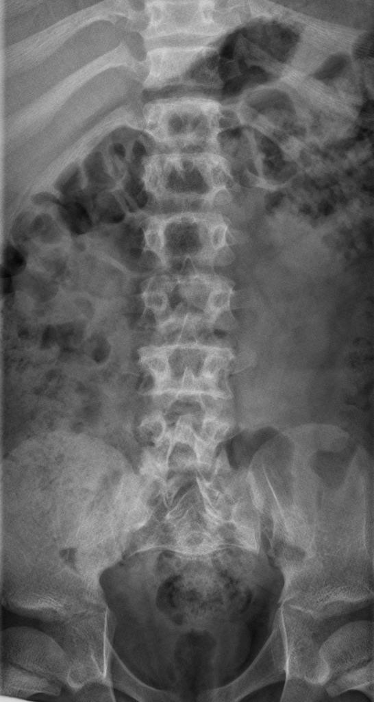 Achondroplasia (9).jpg