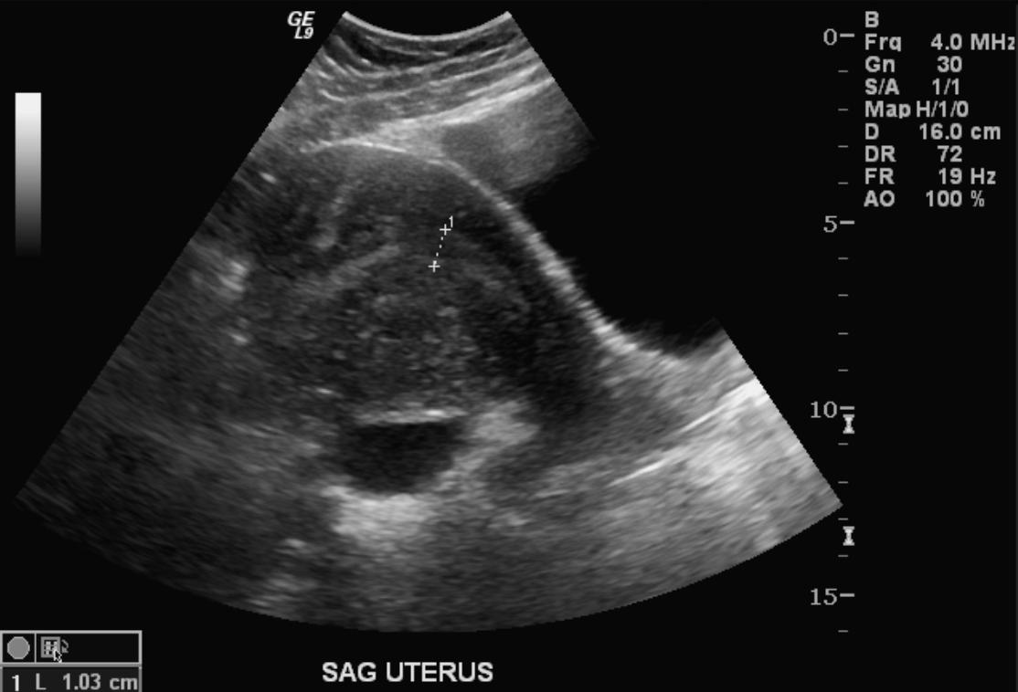 File:Adenomyosis ultrasound 102.jpg
