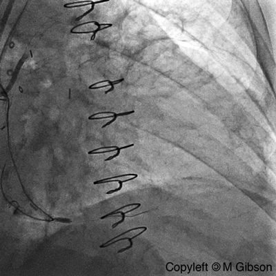 File:Ellis-type-II-coronary-perforation.gif