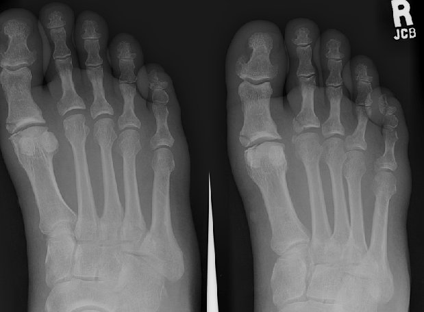 X-ray of foot.