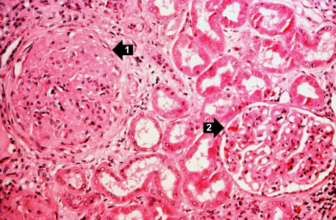 This is a higher-power photomicrograph of hyalinized glomeruli (1) and glomeruli with thickened basement membranes (2).