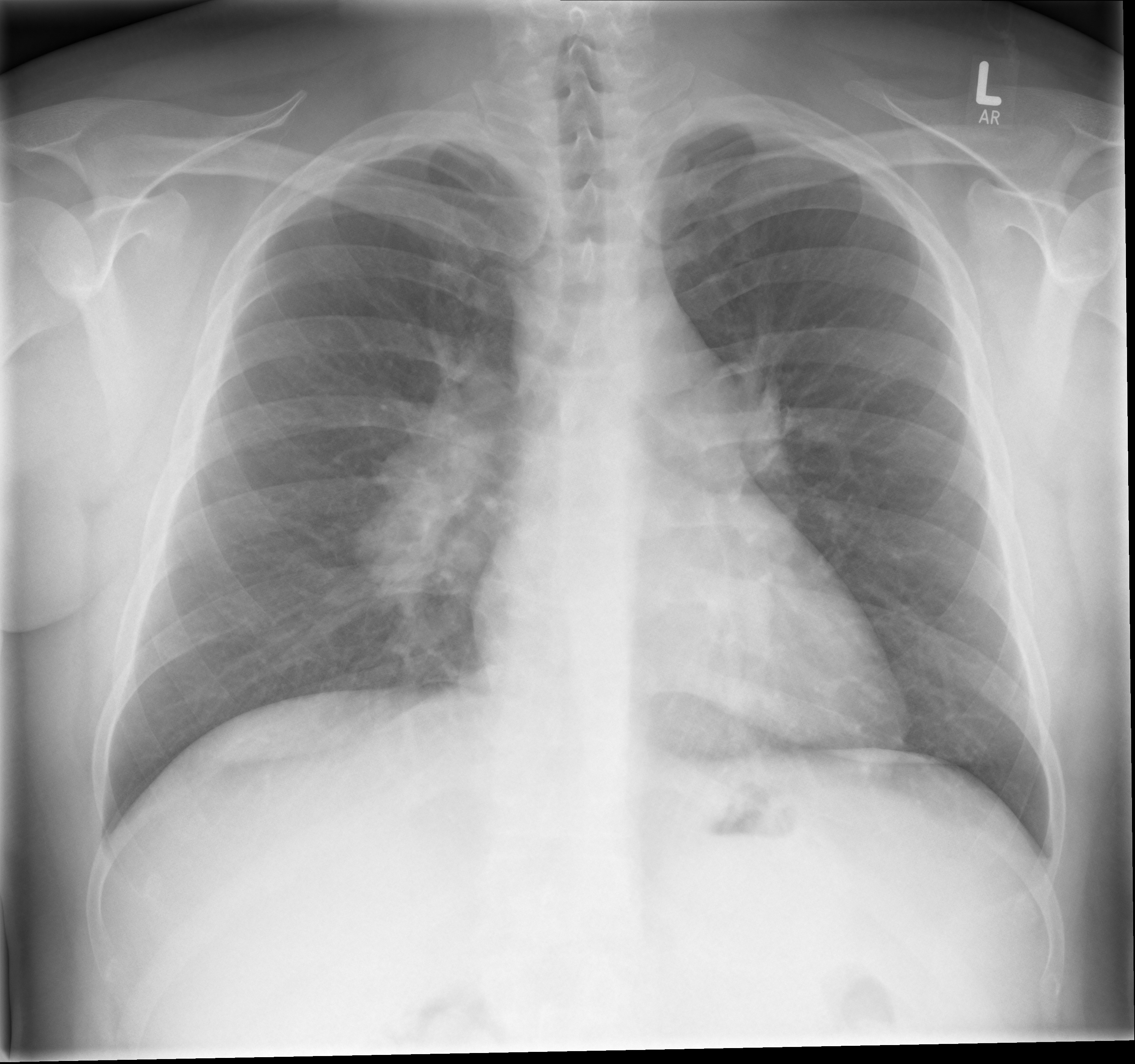 File:Sarcoidosis Chest X-ray.jpg