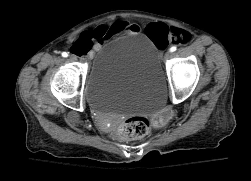 File:Sciatic hernia CT 004.jpg