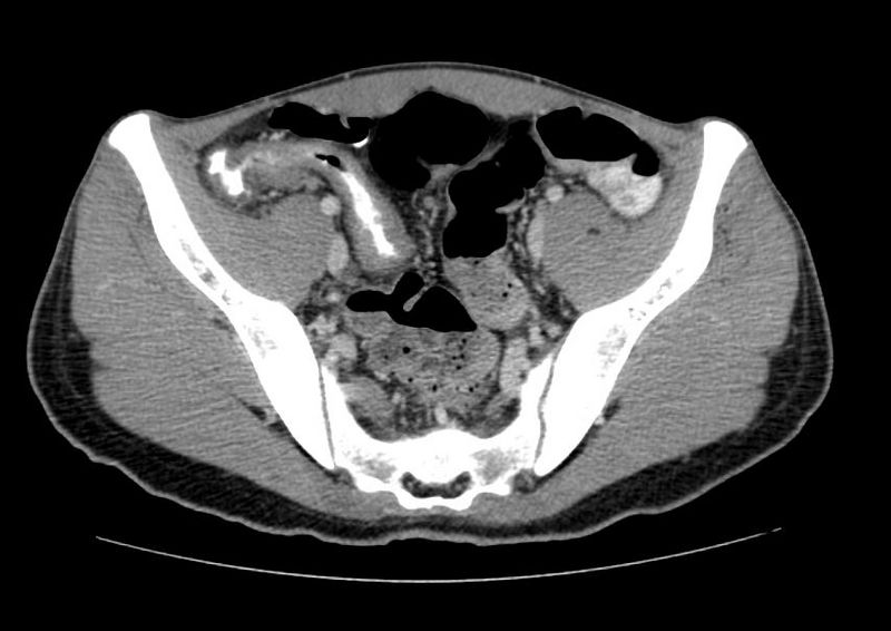 Active Crohn's disease CT