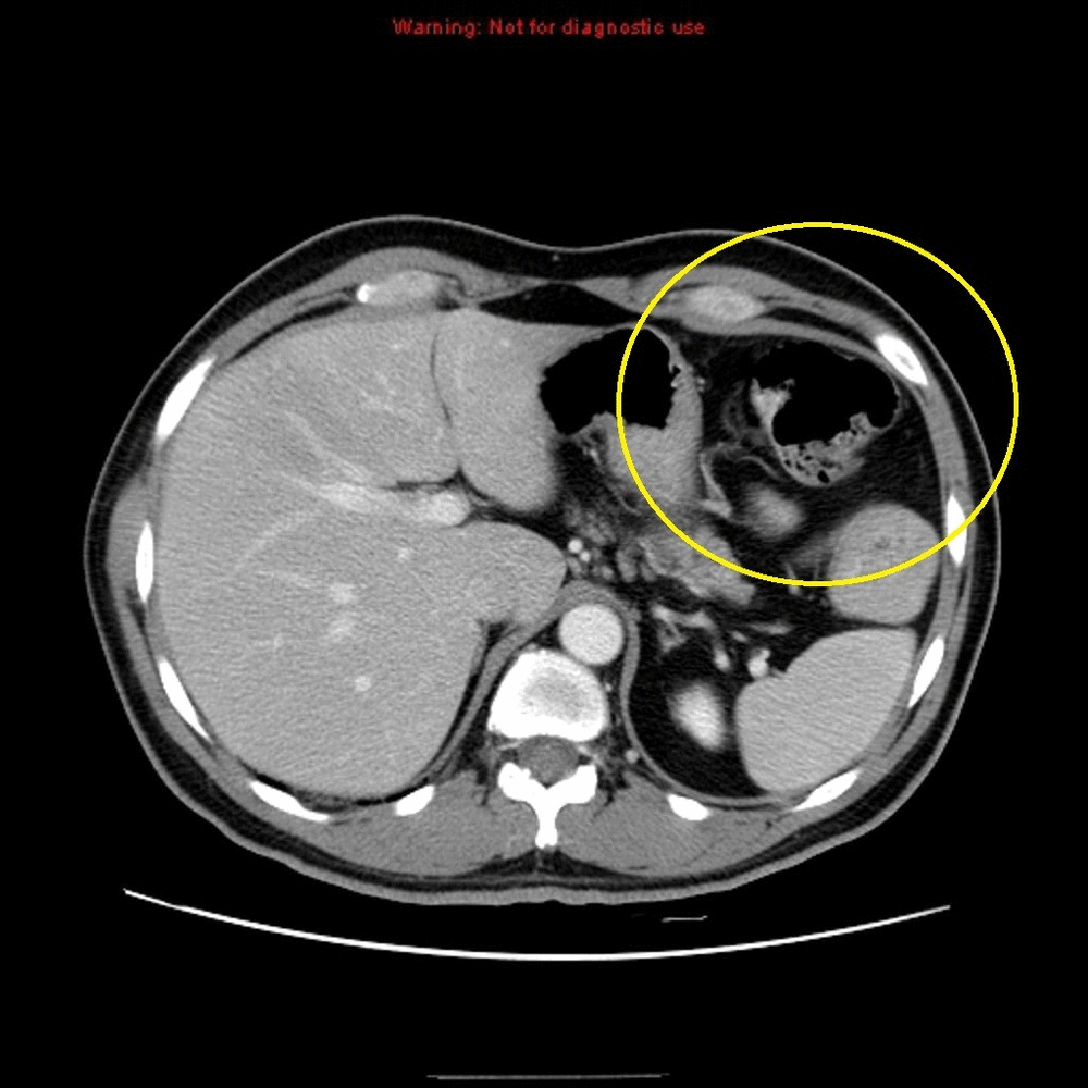 File:CT gastric cancer.gif