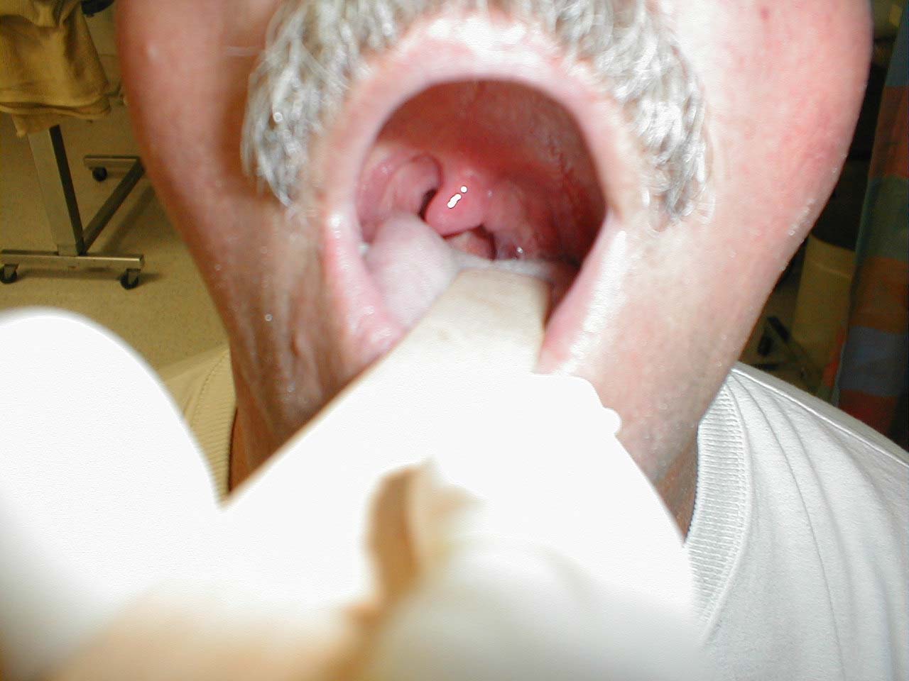 Left peritonsillar abscess; infection within left tonsil has pushed uvula towards the right.