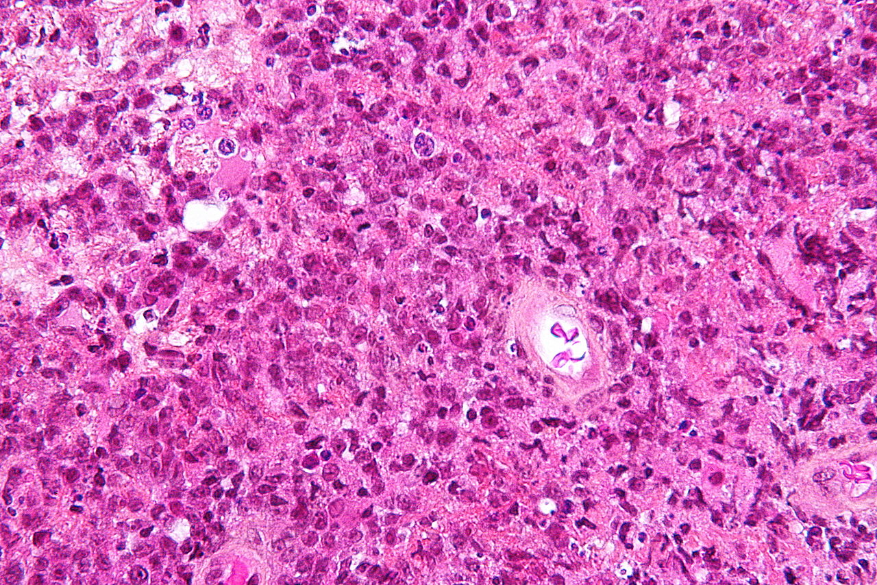 Micrograph from a brain biopsy demonstrating a primary CNS lymphoma with the characteristic perivascular distribution composed of large cells with prominent nucleoli, on HPS stain.[3]