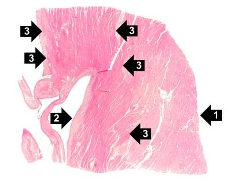 This is a low-power photomicrograph of the left ventricular free wall extending from the epicardium (1) to the endocardium (2). The area of infarction is the darker red (hypereosinophilic area) along the subendocardium (3).