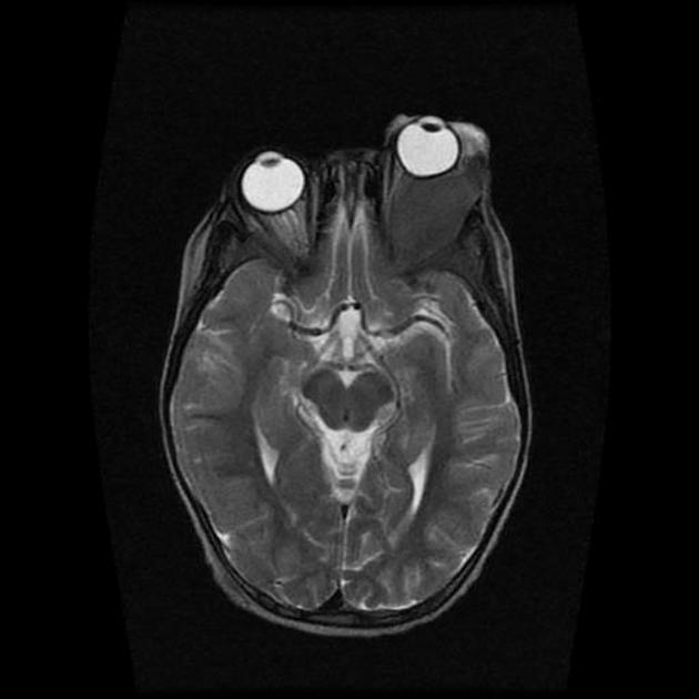 File:Burkitts lymphoma MRI 01.jpg