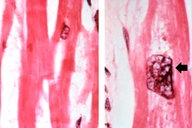 Normal myocardium (left) is compared to hypertrophied myocardium (right). This high power view demonstrates the large dark nuclei (arrow) found in hypertrophied cardiac muscle cells. Polyploidy is a common feature in cardiac hypertrophy. Also note the increased size (thickness) of the individual cardiac muscle cell on the right compared to normal cardiac myocytes (left).
