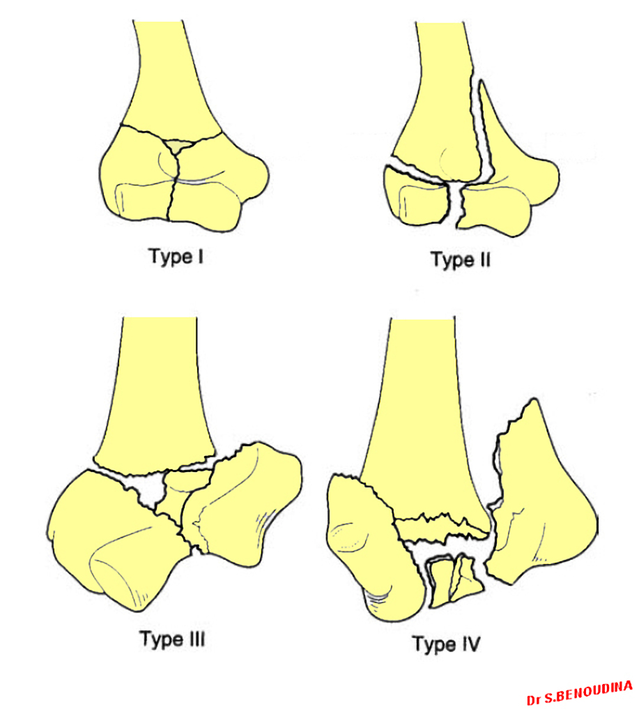 File:Intercondylar-fractures-of-the-humerus-riseborough-and-radin-classification.jpg