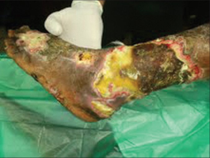 Necrotizing fasciitis involving leg[2]