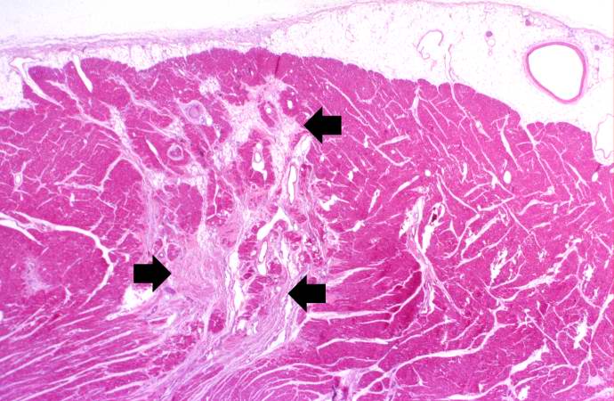 This is a low-power photomicrograph of the heart. There are areas of fibrosis in the myocardium (arrows). Note that the large epicardial coronary artery is normal.