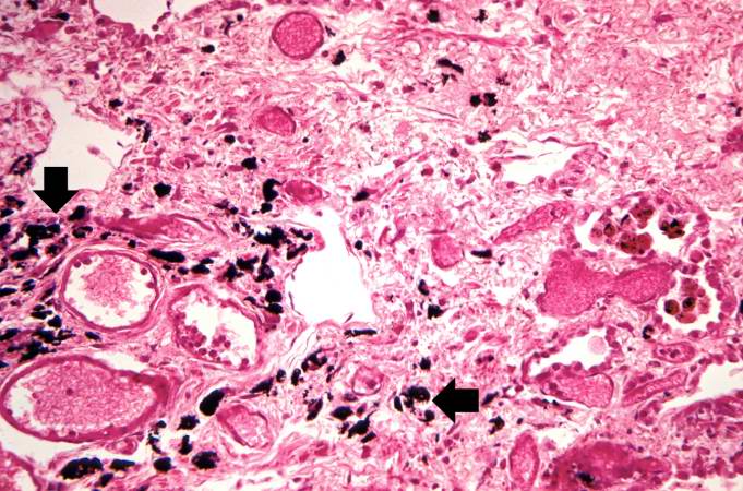This is another high-power photomicrograph of an area of tissue with diffuse fibrosis and thickening of the alveolar septa. There are also accumulations of anthracotic pigment in this area (arrows).