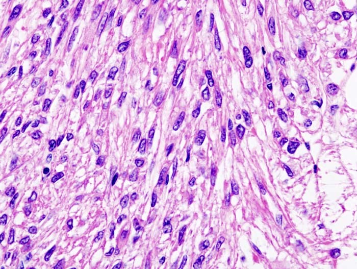 Histopathologic image of renal angiomyolipoma. Nephrectomy specimen. H & E stain.[2]