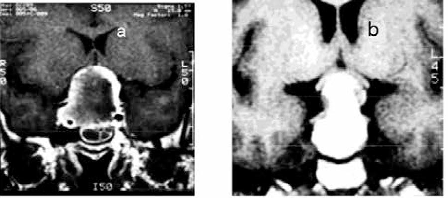 Sellar MRI depicting signs of a acute pituitary apoplexy in two patients (a) a hyperintense lesion impinging optical chiasm in noncontrasted T1-weighted scan and (b) a peripheral rim in a contrasted T1-weighted scan.