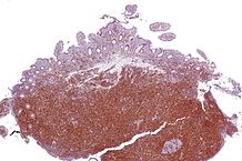 File:218px-Mantle cell lymphoma - low mag - cyclin D1.jpg