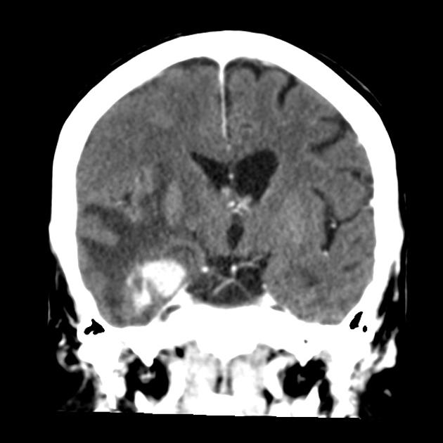 Contrast CT scan of a 60 year old hispanic female with known history of metastatic breast cancer demonstrates two round lesions with ring-shaped enhancement in the right temporal region with perilesional edema.[10]
