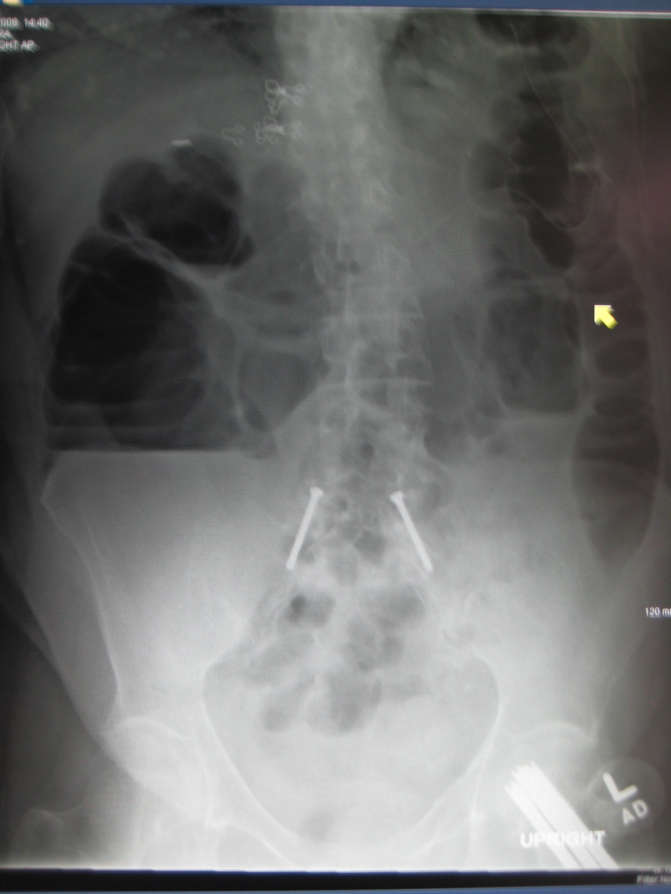 Upright abdominal X-ray of a patient with a large bowel obstruction showing multiple air fluid levels and dilated loops of bowel.