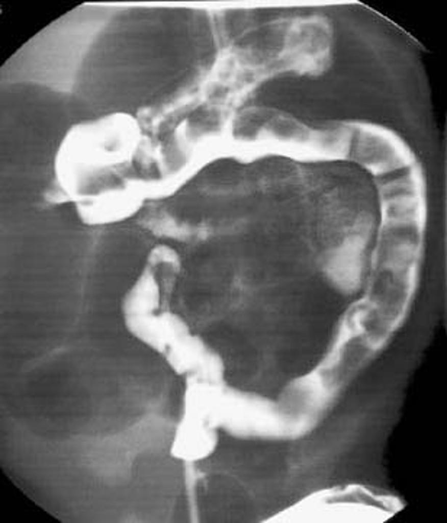 File:Meconium-plug-syndrome - Case courtesy of Radswiki, Radiopaedia.org, rID 11606.jpg