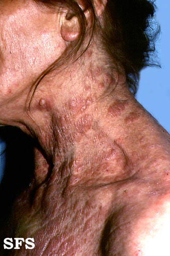 url = http://www.atlasdermatologico.com.br/disease.jsf?diseaseId=308>