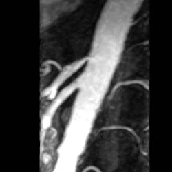 File:Renal artery stenosis 014.jpg