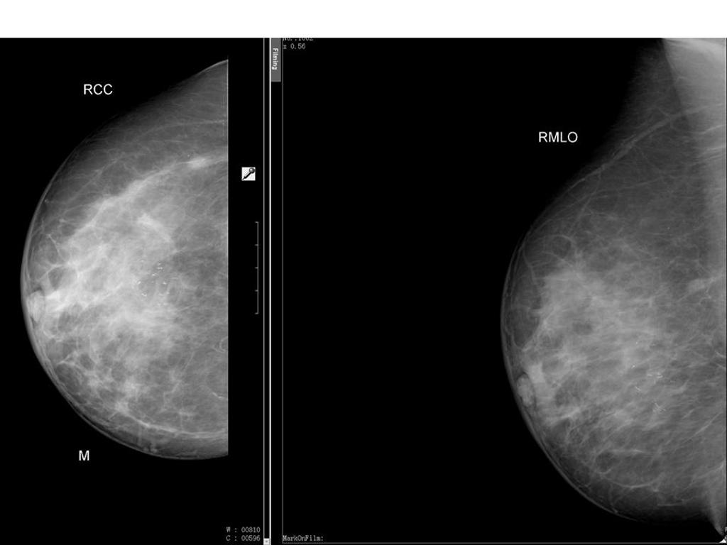 File:Screening-mammogram-microcalcifications.jpg