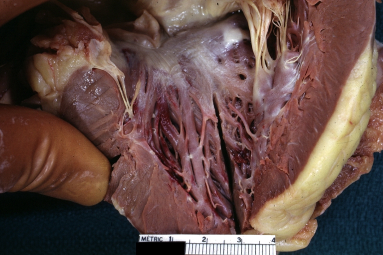 Hypertrophic Obstructive Cardiomyopathy: Gross natural color opened left ventricular outflow tract with subaortic shelf and marked endocardial thickening matching the contour of the anterior mitral leaflet