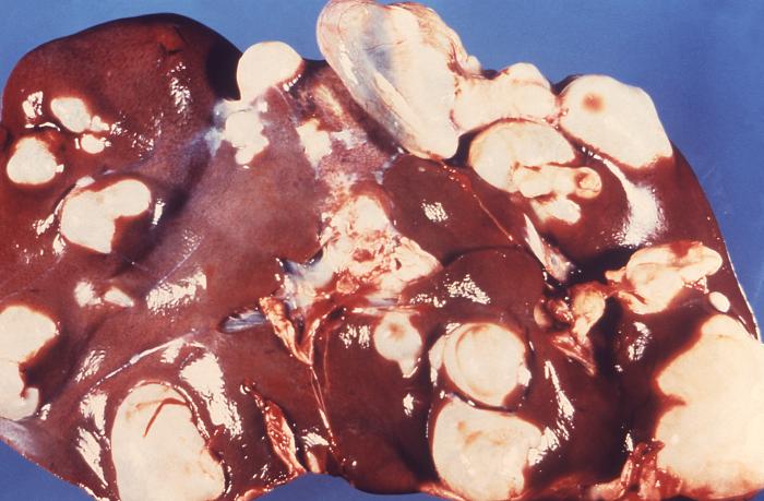 Image depicts a sheep’s liver extracted at this animal’s necropsy, revealing the presence of numerous cysts in a case of hepatic echinococcosis due to the tapeworm, Echinococcus granulosus. From Public Health Image Library (PHIL). [1]
