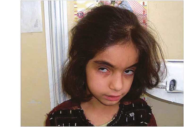 Joubert syndrome patient with strabismus and large forehead
