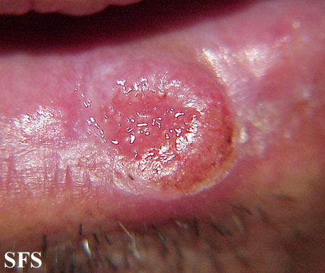 File:Squamous cell carcinoma 23.jpeg
