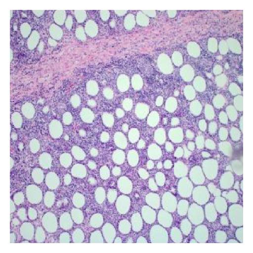 Biopsy of soft tissue : at 10x magnification shows lymphoid infiltrate with pattern resembling lobular and septal panniculitis[2]