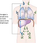 File:124px-Diagram showing stage 3 Hodgkin's lymphoma CRUK 221.svg.png