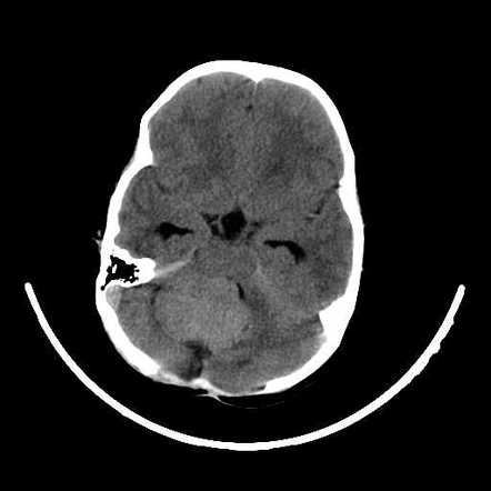 Medulloblastoma non-contrast CT scan[1]