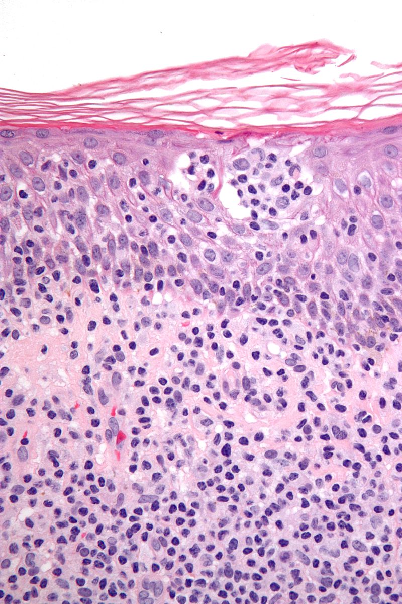 File:Cutaneous T-cell lymphoma - very high mag.jpg