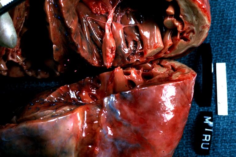 Papillary Muscle Infarct with Rupture: Gross, left ventricle opened partially to show infarct and ruptured muscle, an excellent example