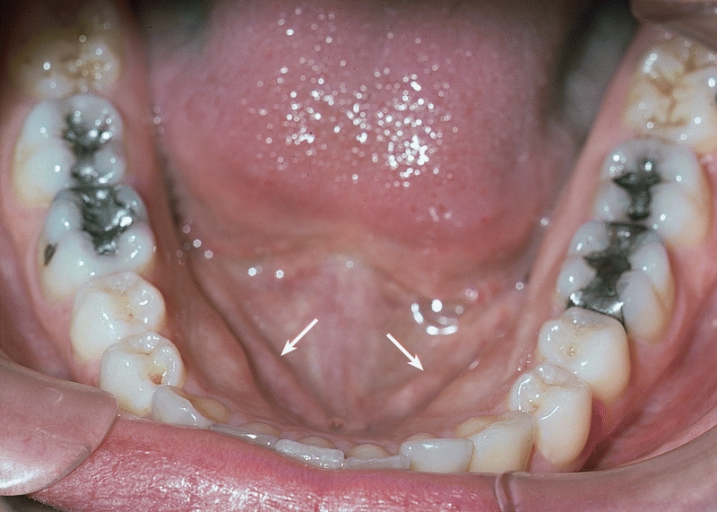 SALIVARY GLANDS: WHARTON'S DUCT: The right and left submandibular ducts (arrows) course anteriomedially in the floor of the mouth to openings at the lingual carunculae, which are only a few millimeters apart.