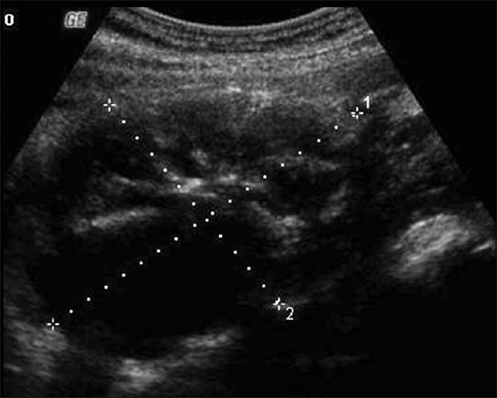 File:Struma ovarii Transabdomen grayscale US.jpg