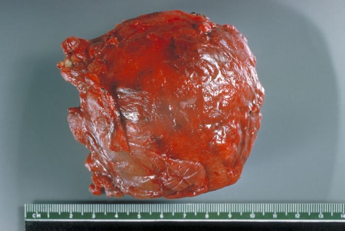 Gross pathology of hydatid cyst from human lung. From Public Health Image Library (PHIL). [1]