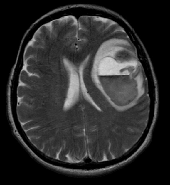 Axial T2 MRI scan of 60 year old female with known history of malignant melanoma, complaining of acute right hemiplegia, aphasia, and confusion, demonstrates a large cerebral haematoma with a fluid-fluid level. There is a smaller low signal area anteriorly which corresponded to the known metastasis. This smaller area enhanced after gadolinium, as did the overlying dura.[4]