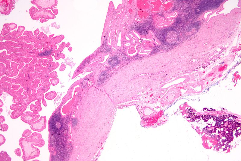File:Papillary cystadenoma lymphomato 01.jpg
