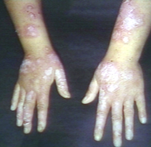 Skin: Lupus, systemic erythematosus; Discoid skin lesion in patient with SLE. Image courtesy of Professor Peter Anderson DVM PhD and published with permission © PEIR, University of Alabama at Birmingham, Department of Pathology.[9]