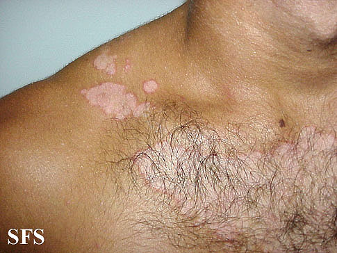 Upper chest showing redness and crusting. - Adapted from Dermatology Atlas.[27]