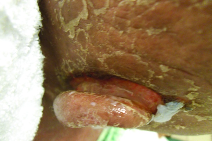 File:Knife-cut sign in a immunodeficient patient.jpg