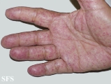 Osler weber rendu disease. With permission from Dermatology Atlas.[3]