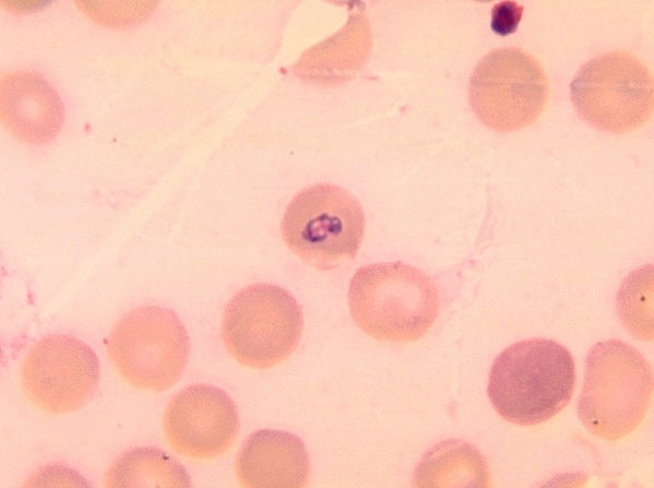 Blood smear showing larger trophic stage of Babesia microti in erythrocyte. From Public Health Image Library (PHIL). [2]