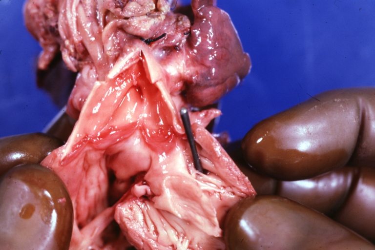 Interventricular Septal Defect (Muscular Septum): Gross natural color right ventricular outlet (probe in defect) view from left ventricular side