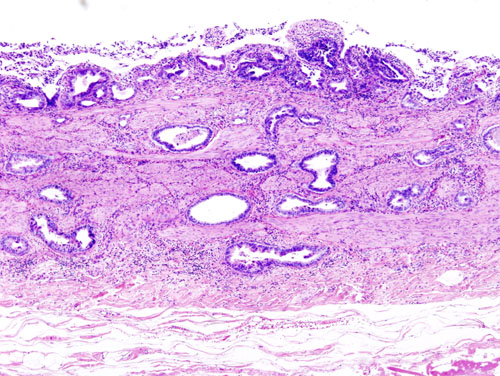 Gallbladder adenocarcinoma: Incidentally discovered gallbladder cancer (adenocarcinoma) following a cholecystectomy. H&E stain