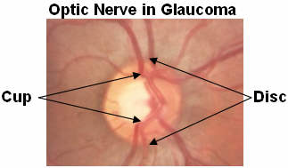 Glaucoma,optic nerve.jpg